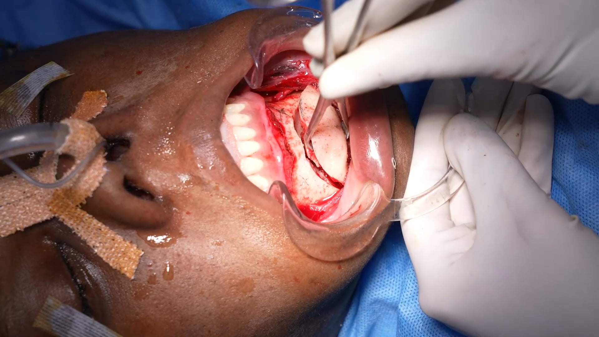 Complete Facemakeover Surgery